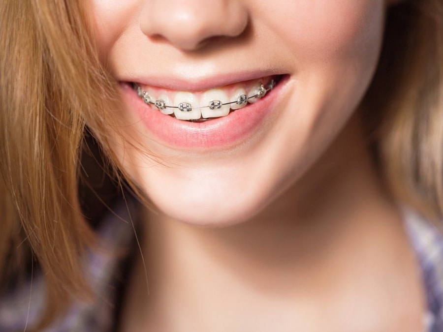 bảng giá niềng răng nha trang