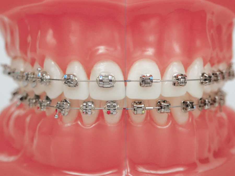 bảng giá niềng răng nha trang