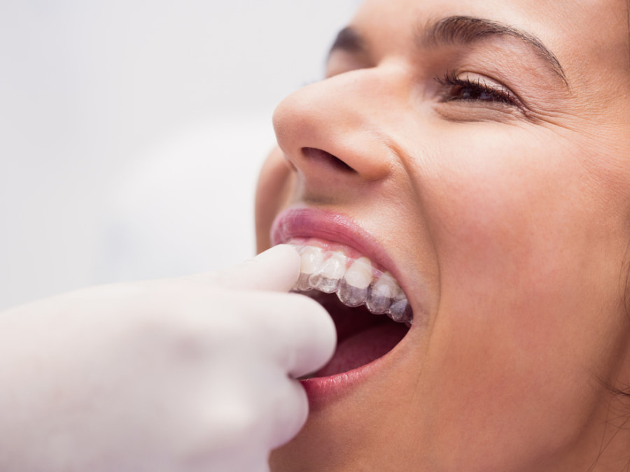 bảng giá niềng răng nha trang